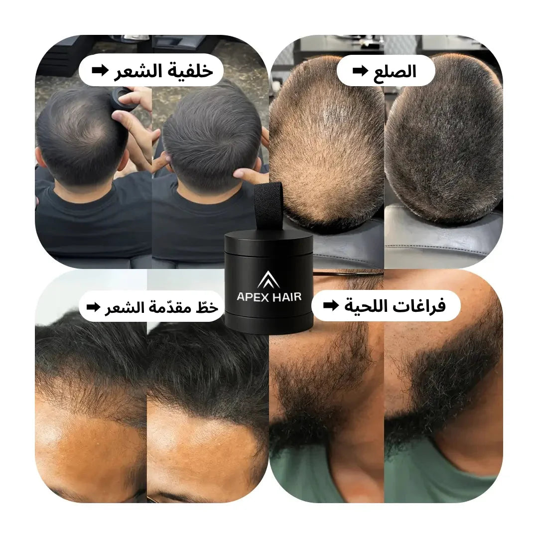 بودرة لمحاربة الصلع